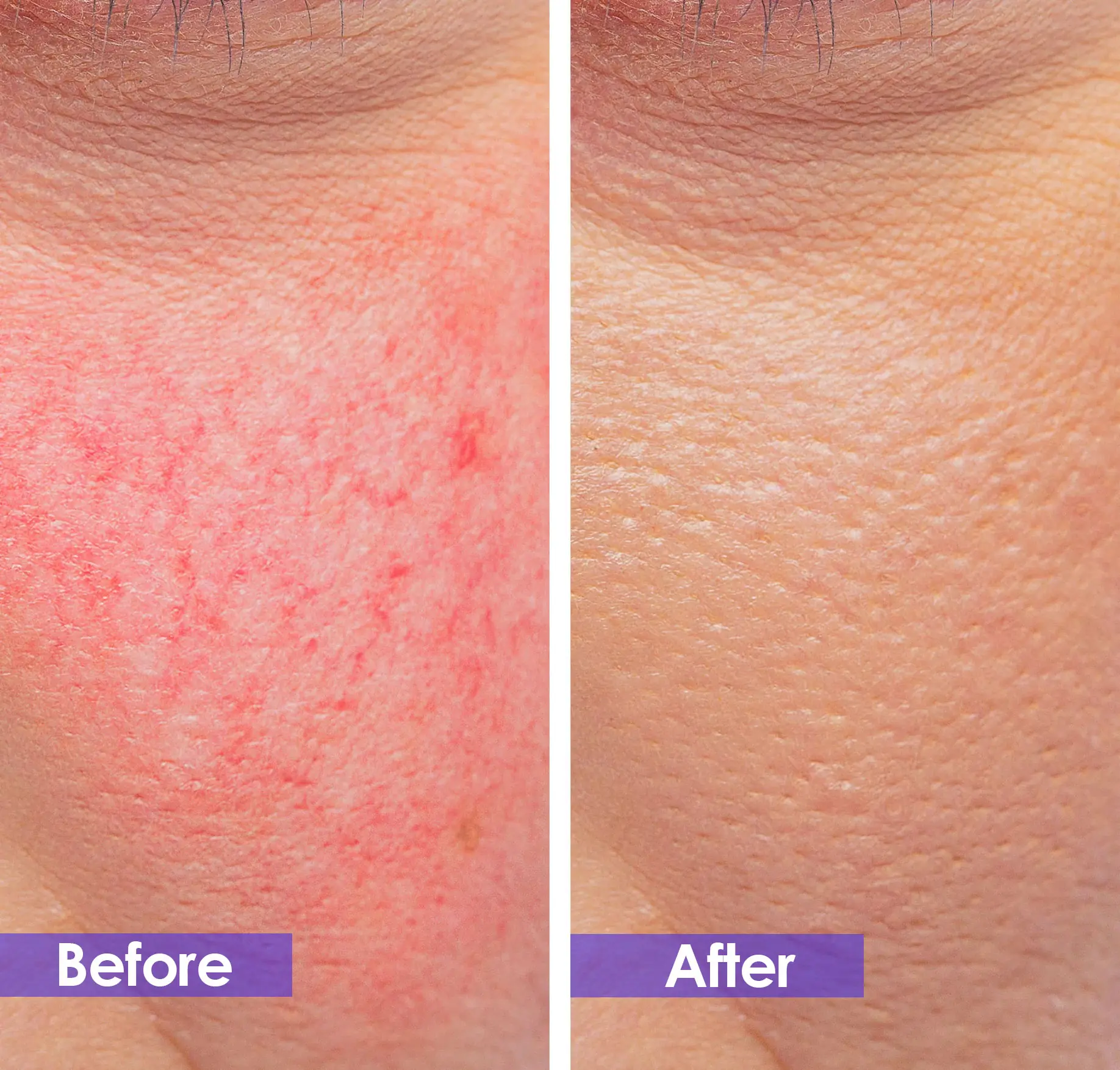 spider veins removal before and after
